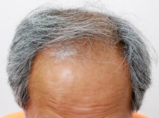 薄毛治療(AGA) 半年後