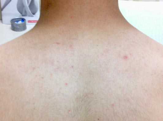 メンズ脱毛 施術後