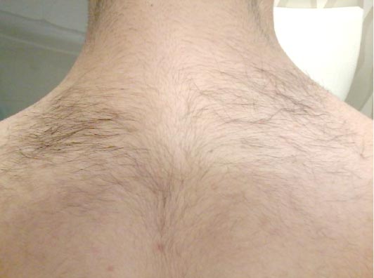 メンズ脱毛 施術前