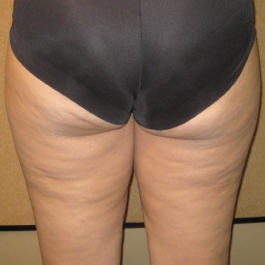 痩身施術10回後